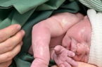 تولد نخستین نوزاد حاصل از پیوند رباتیک رحم