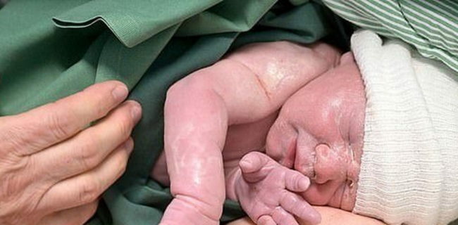 تولد نخستین نوزاد حاصل از پیوند رباتیک رحم