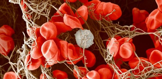 عارضه جدید ابتلا به کرونا که با بروز لخته خون در پا‌ی بیماران همراه است