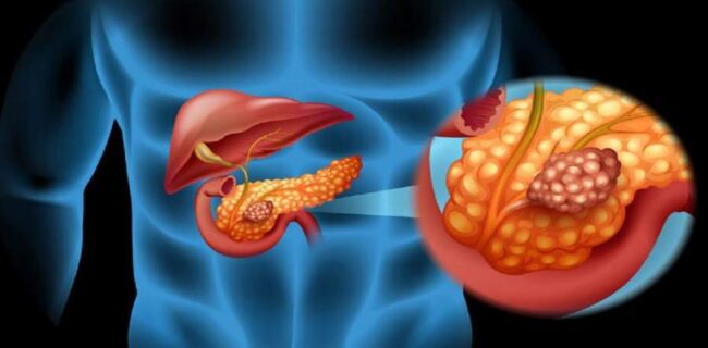 سرطان پانکراس در بدن شما ریشه دوانده اگر این نشانه‌ها را دارید!